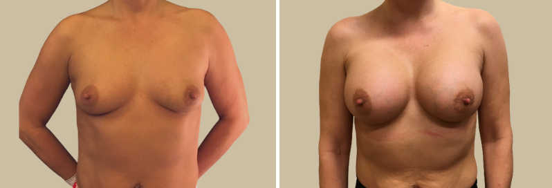zvětšení prsou augmentace